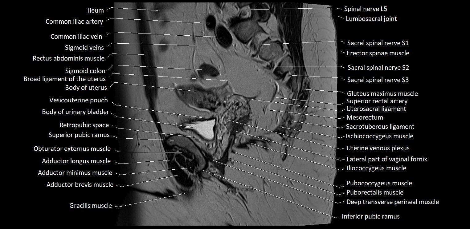 Sagittal cross sectional anatomy of female pelvis (MRI 3T) image 28.webp